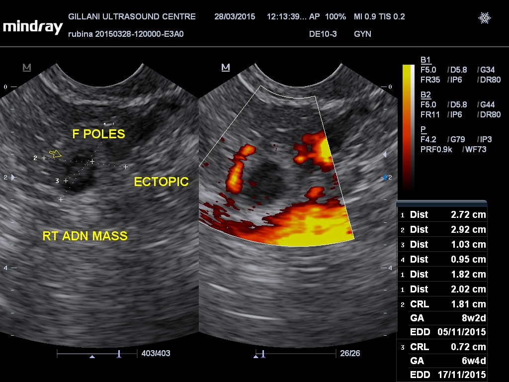 201503281214480014GYN